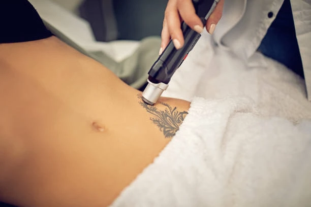 picoway laser tattoo removal in wasilla alaska