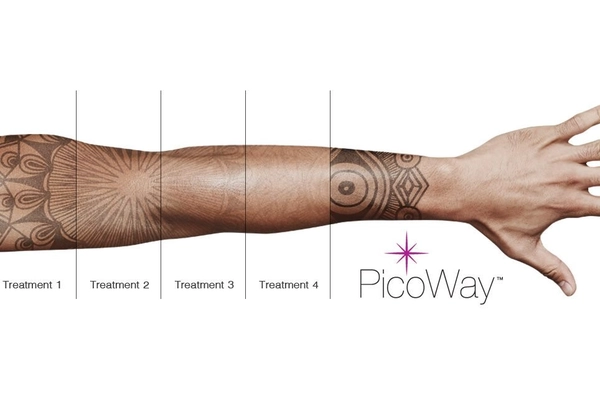 tattoo removal by picoway