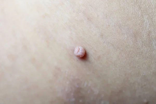 skin tag removal service wasilla ak