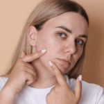 laser treatment for acne scars