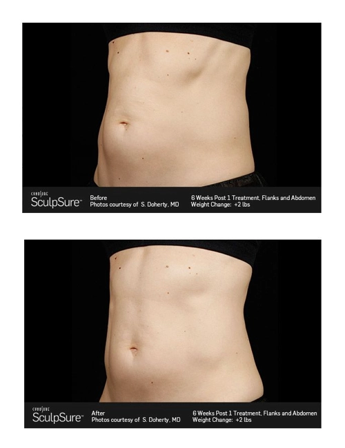 sculpsure before after alaska