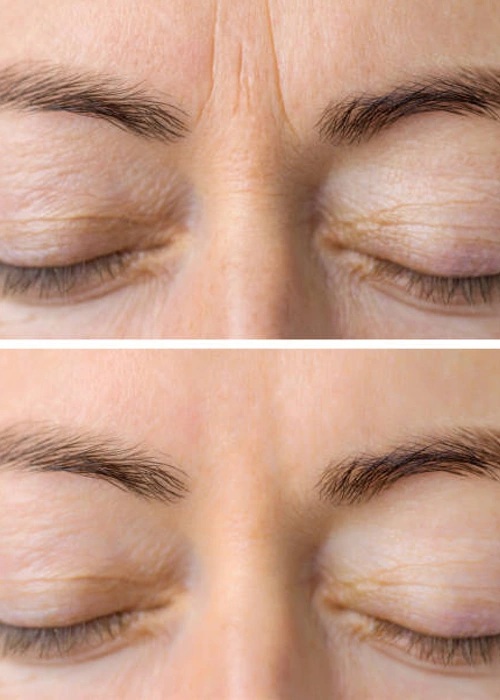 skin filler radiesse before after